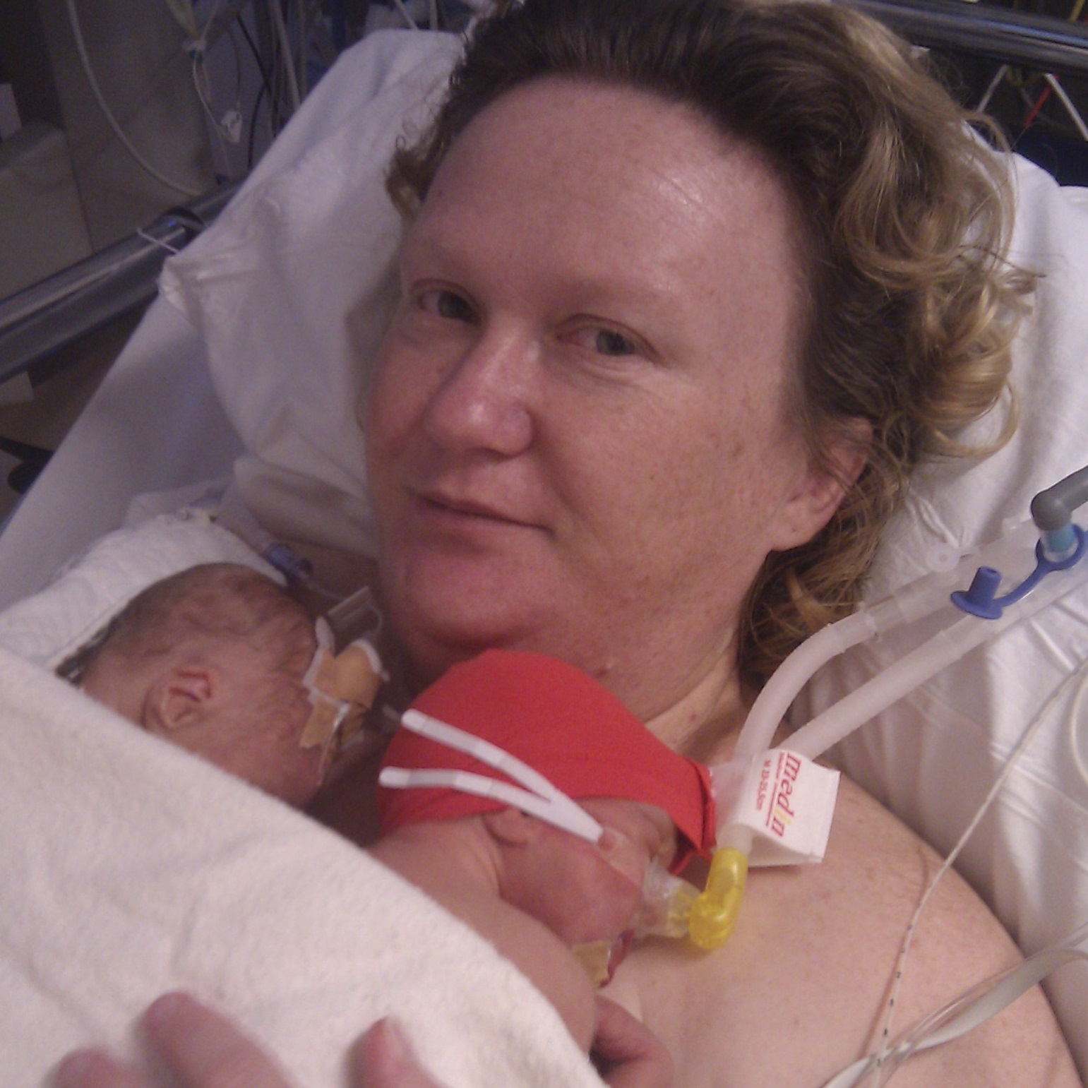 Mother with twins doing kangaroo mother care at the nicu